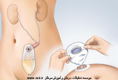 درمان: بعد از جراحی