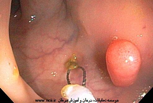 غربالگری سرطان روده بزرگ و راست‌روده