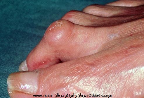 انگشت پای چکشی