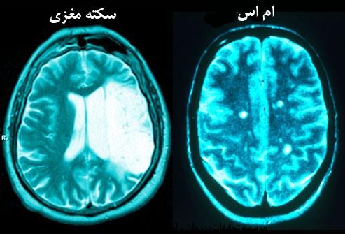 سكته مغزي در مقابل ام اس