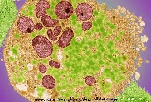 انواع سرطان مثانه