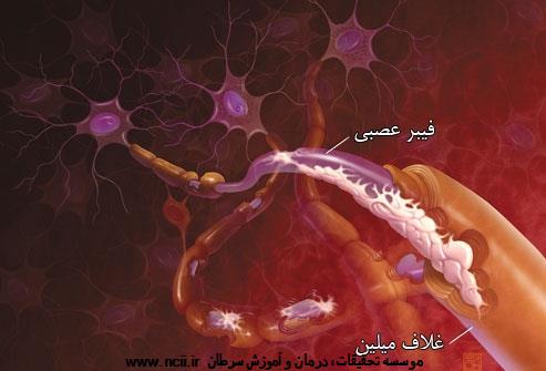 چطور بيماري ام اس حمله مي‌كند.