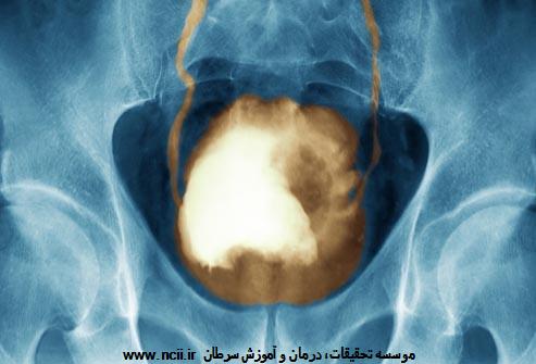 علائم هشدار : وجود تغییراتی در مثانه