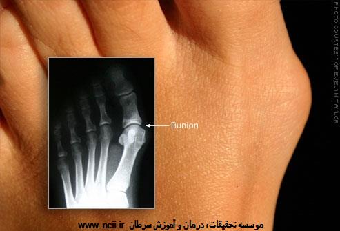 هالوس والگوس (قوزک شست پا)