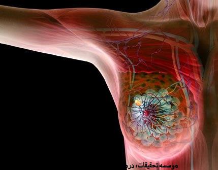 آنچه باید در مورد سرطان پستان بدانید