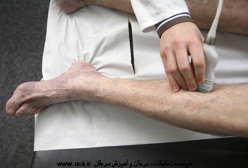 تشخیص DVT