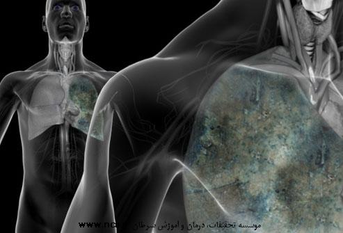 آنچه باید در مورد سرطان ریه بدانید