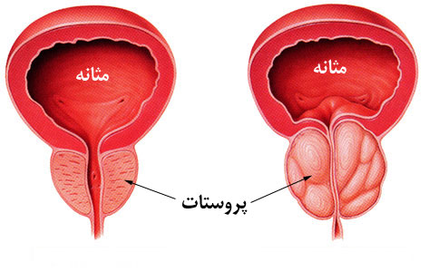 آنچه بايد در مورد سرطان پروستات بدانید